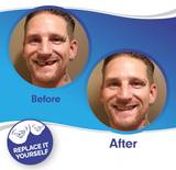 Snap-On Smile Veneers