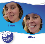 Snap-On Smile Veneers